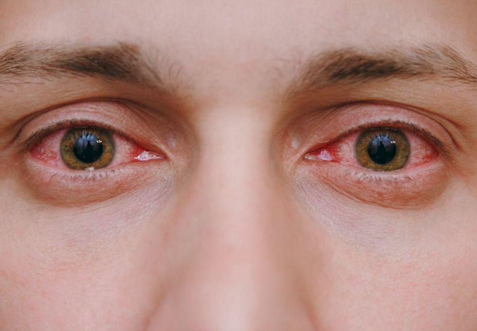 Conjunctivitis (bacterial, viral and allergic)
